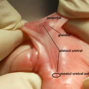 Hipospadias Penoscrotal